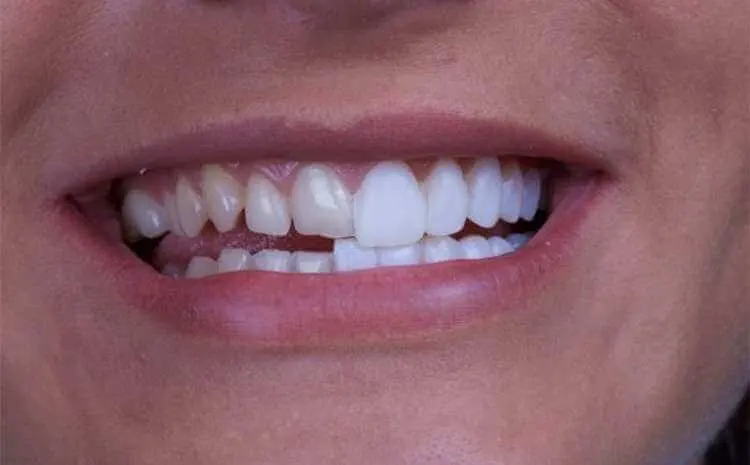 Dental-Veneers-In-Pakistan1